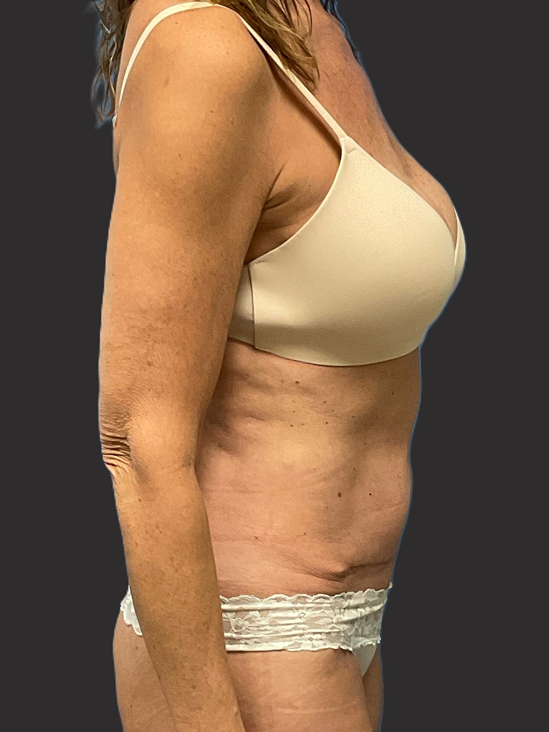 Mini Tummy Tuck Before & After