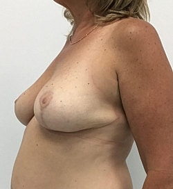 Breast Lift Before & After
