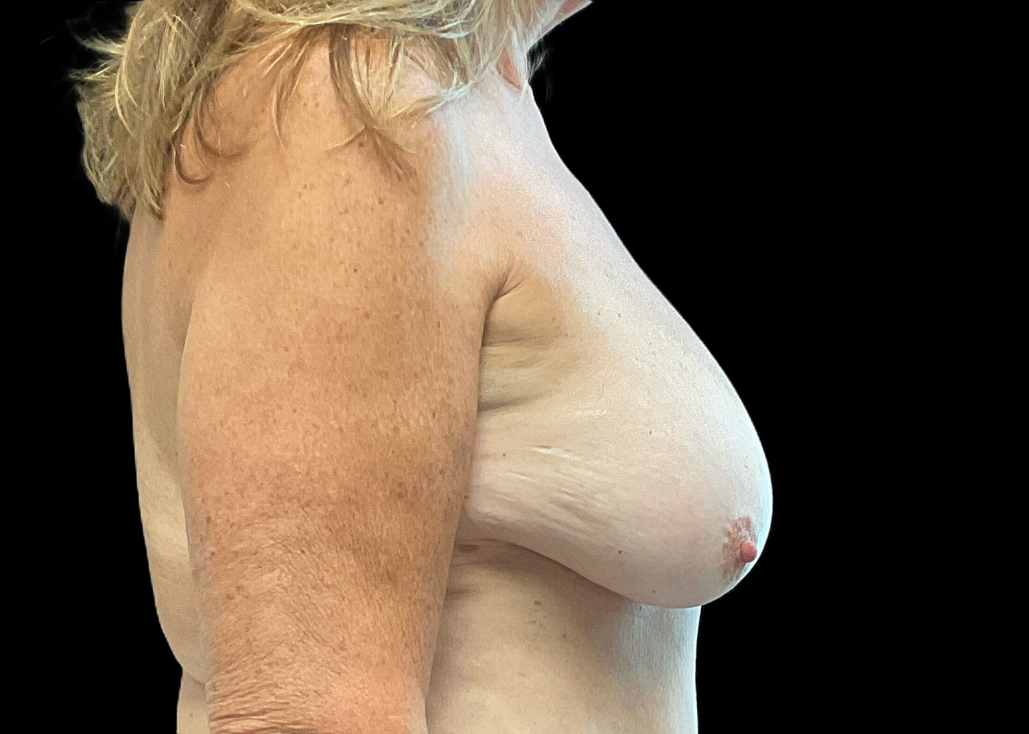 Breast Lift Before & After