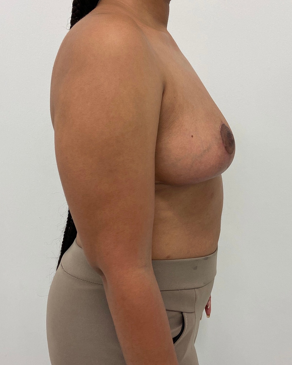 Breast Lift Before & After