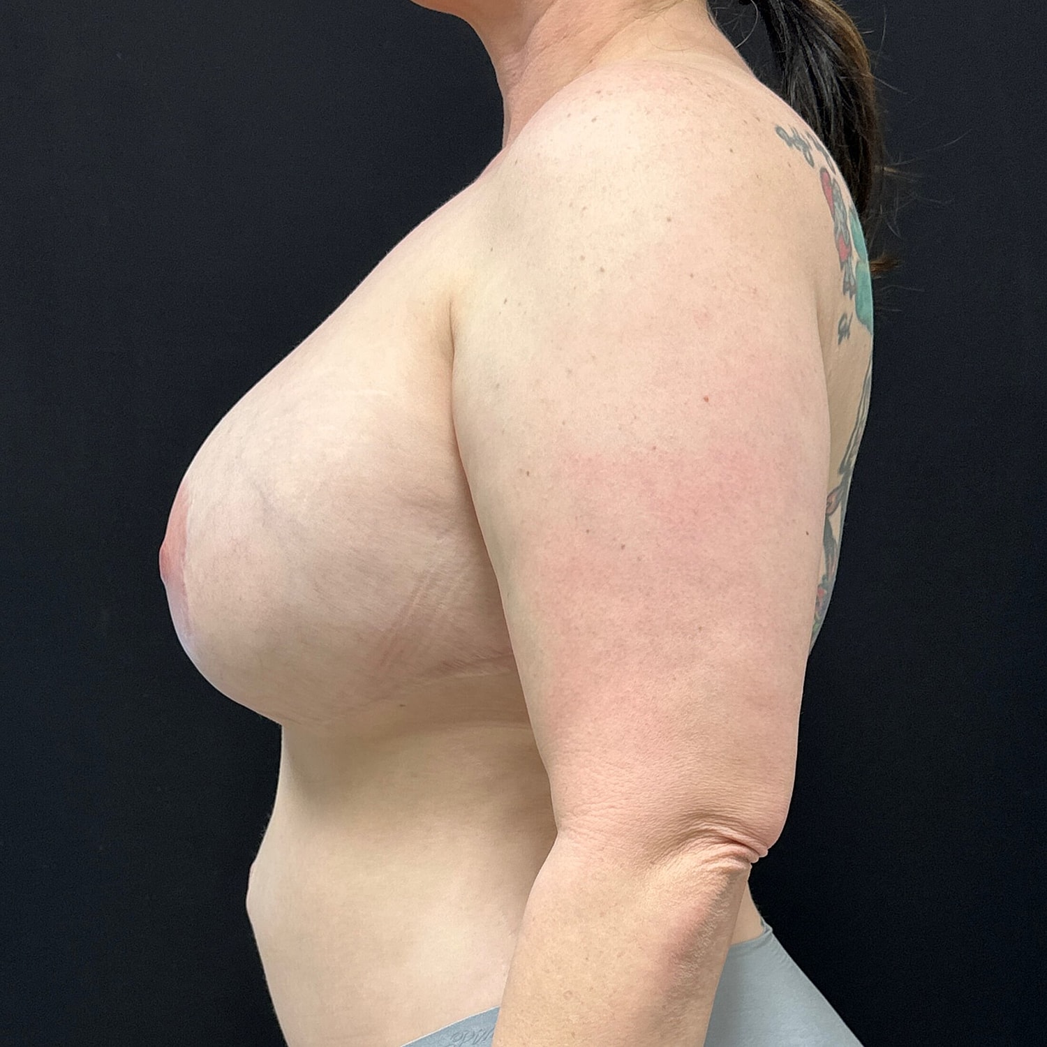 Breast Implant Removal Before & After