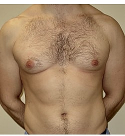 Gynecomastia Surgery Before & After
