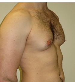 Gynecomastia Surgery Before & After