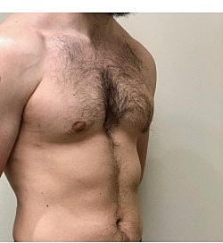 Gynecomastia Surgery Before & After