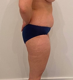 Abdominoplasty Before & After