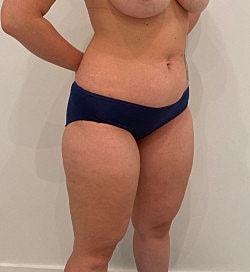 Abdominoplasty Before & After