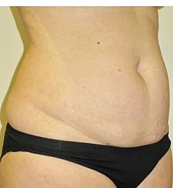 Abdominoplasty Before & After