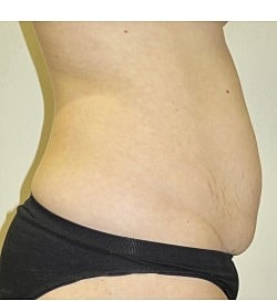 Abdominoplasty Before & After