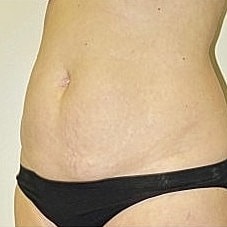 Abdominoplasty Before & After