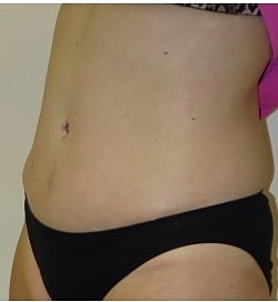 Abdominoplasty Before & After