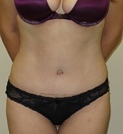 Abdominoplasty Before & After