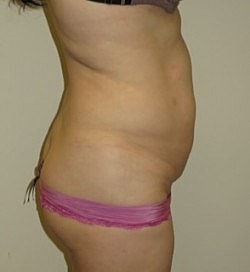 Abdominoplasty Before & After
