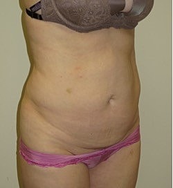 Abdominoplasty Before & After