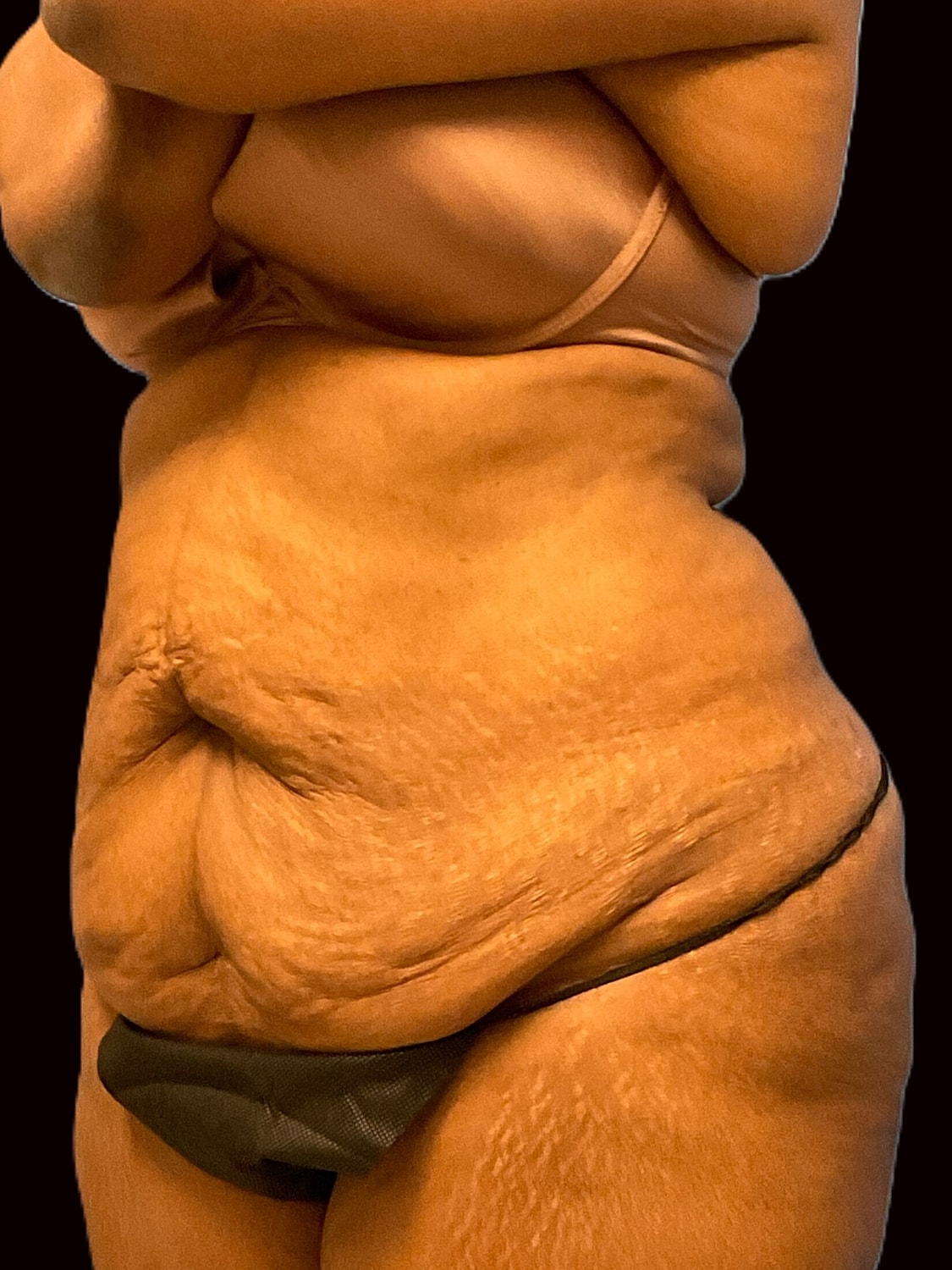 Tummy Tuck Before & After