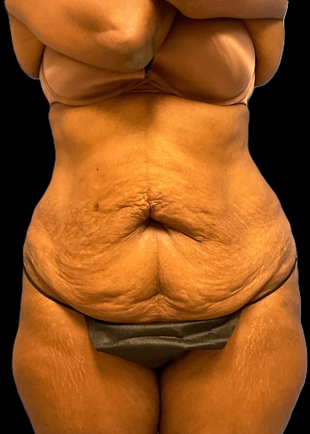 Tummy Tuck Before & After