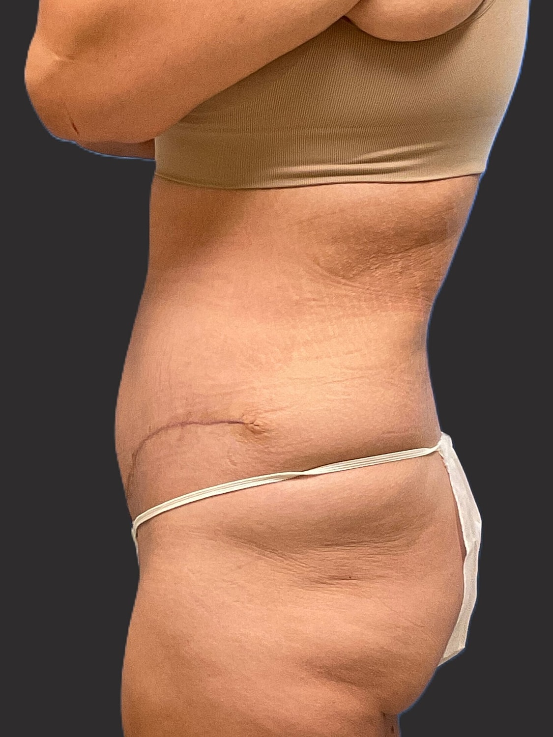 Tummy Tuck Before & After