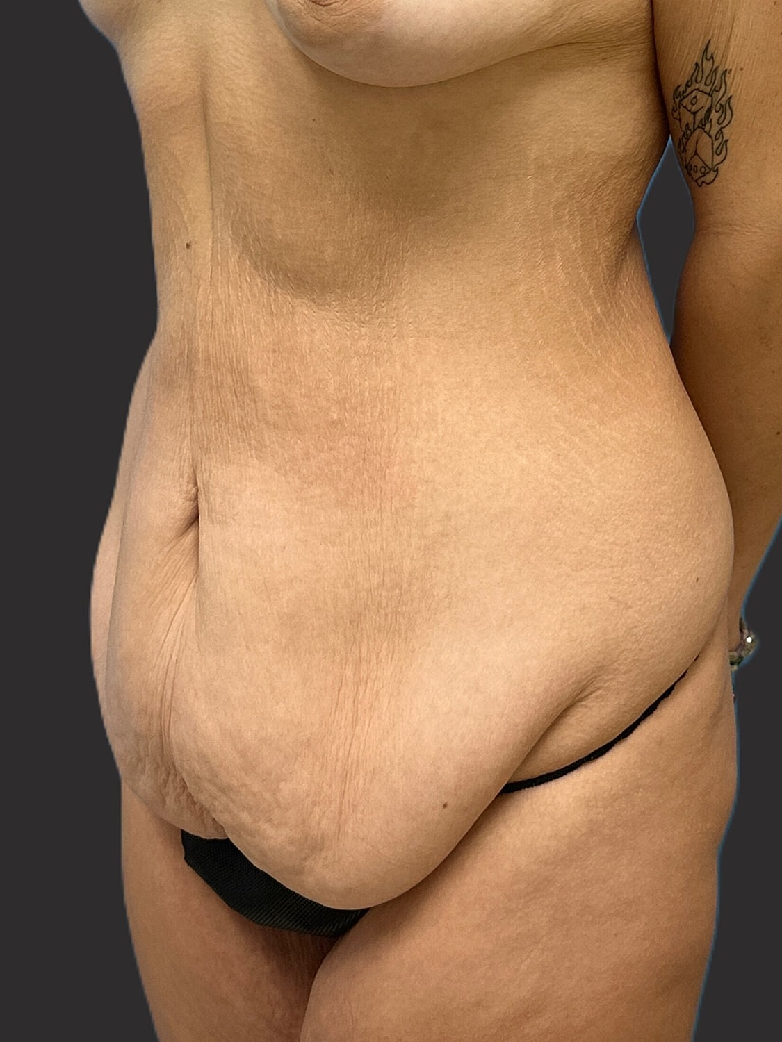 Tummy Tuck Before & After