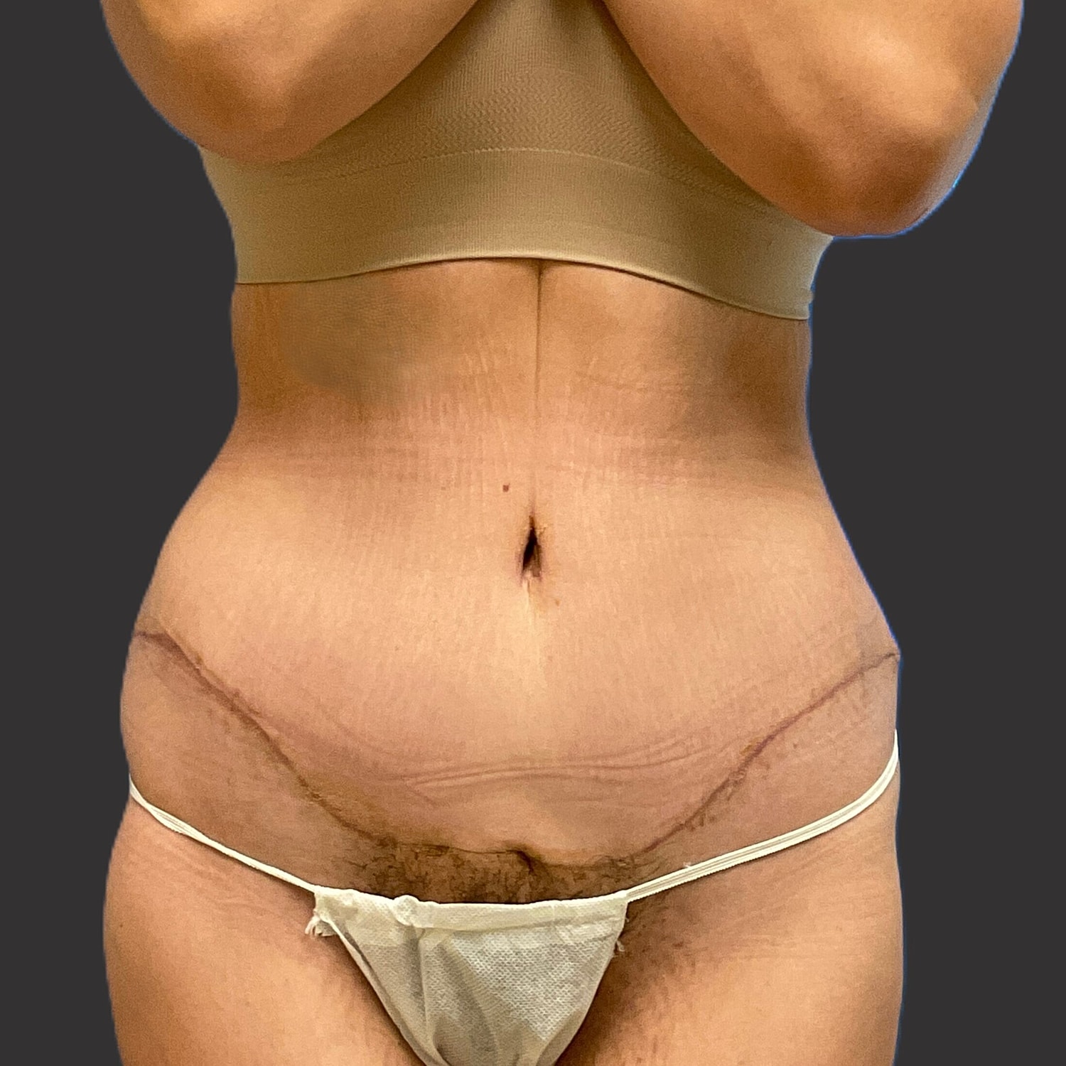 Tummy Tuck Before & After