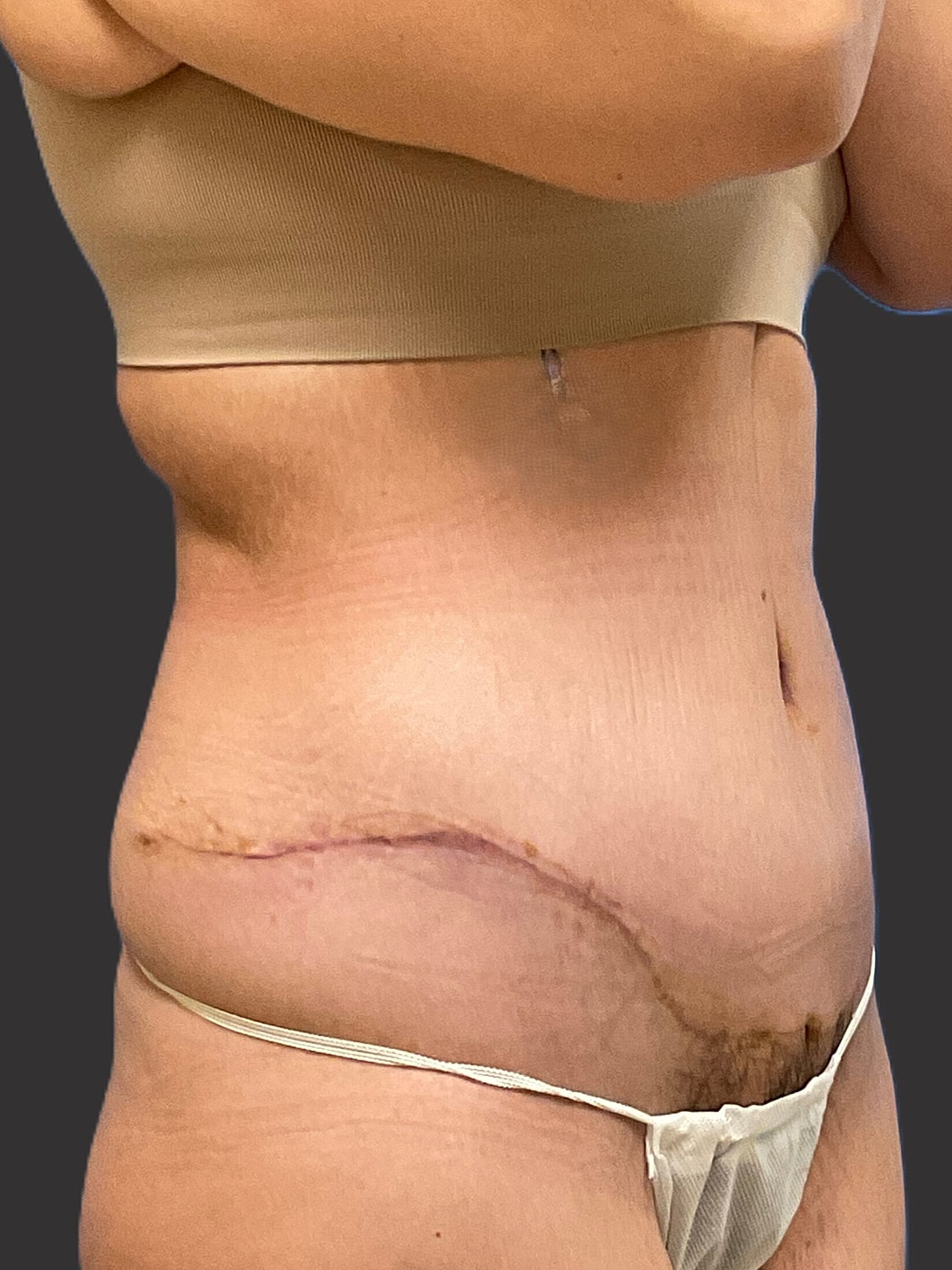 Tummy Tuck Before & After