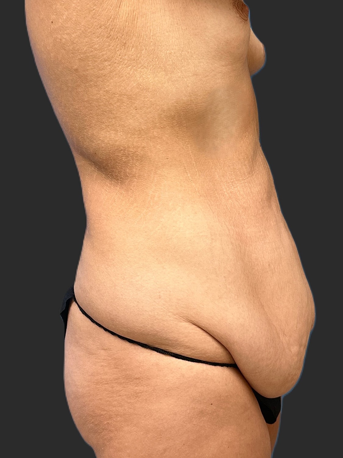 Tummy Tuck Before & After