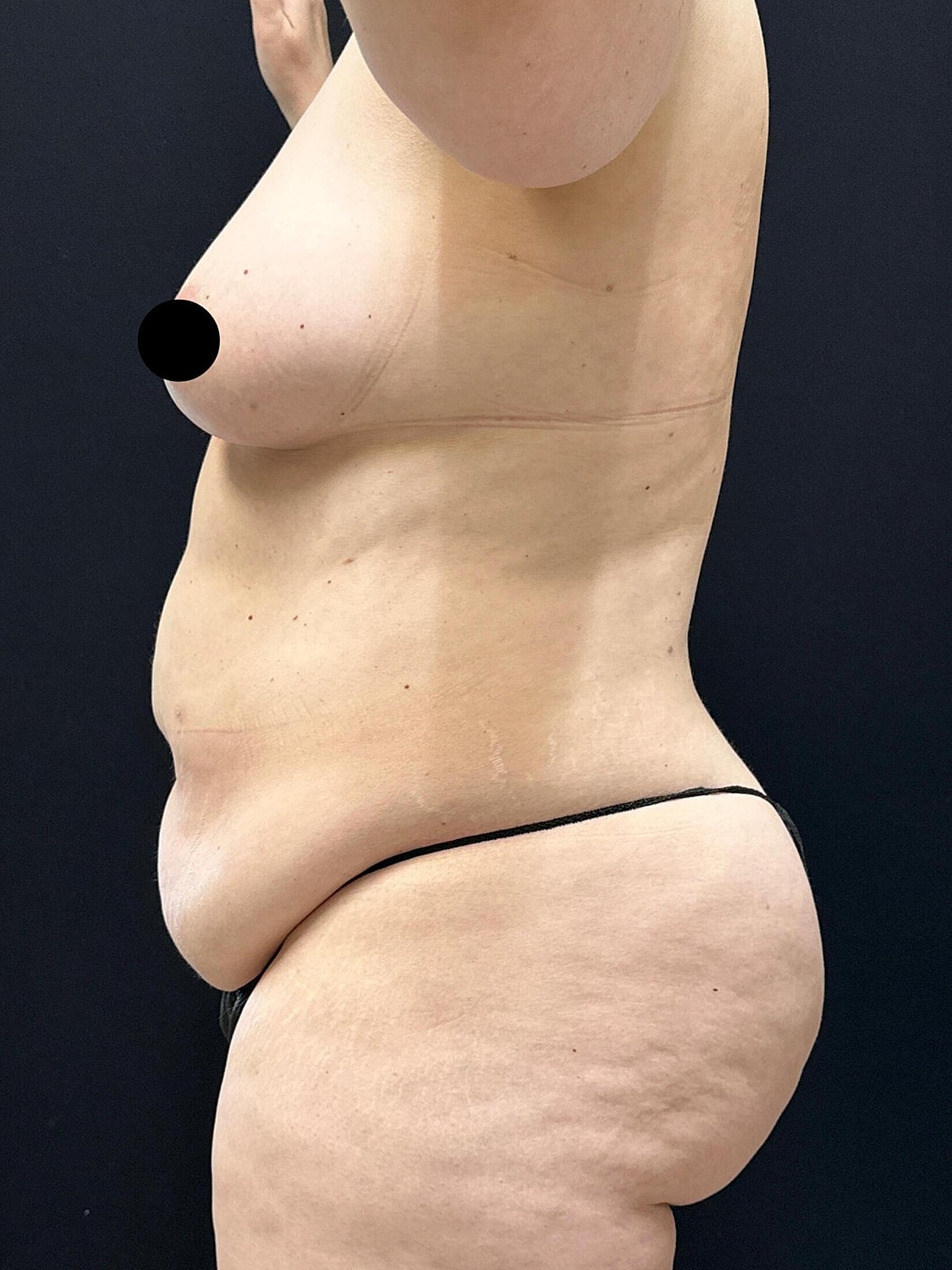 Tummy Tuck Before & After