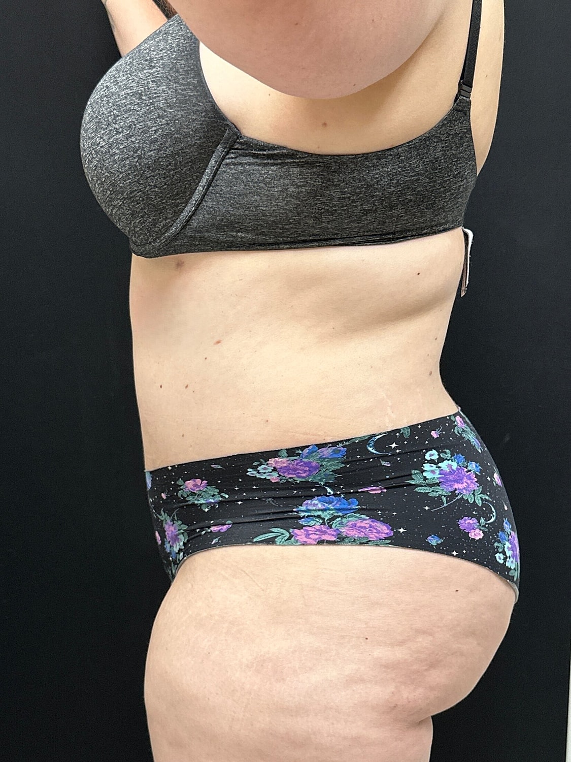 Tummy Tuck Before & After