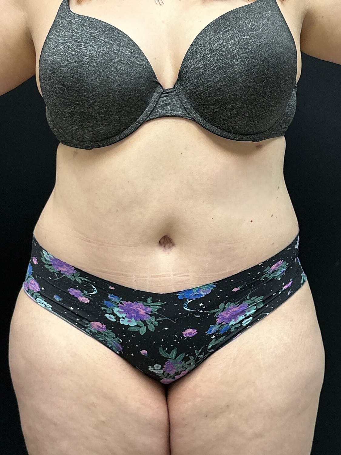 Tummy Tuck Before & After