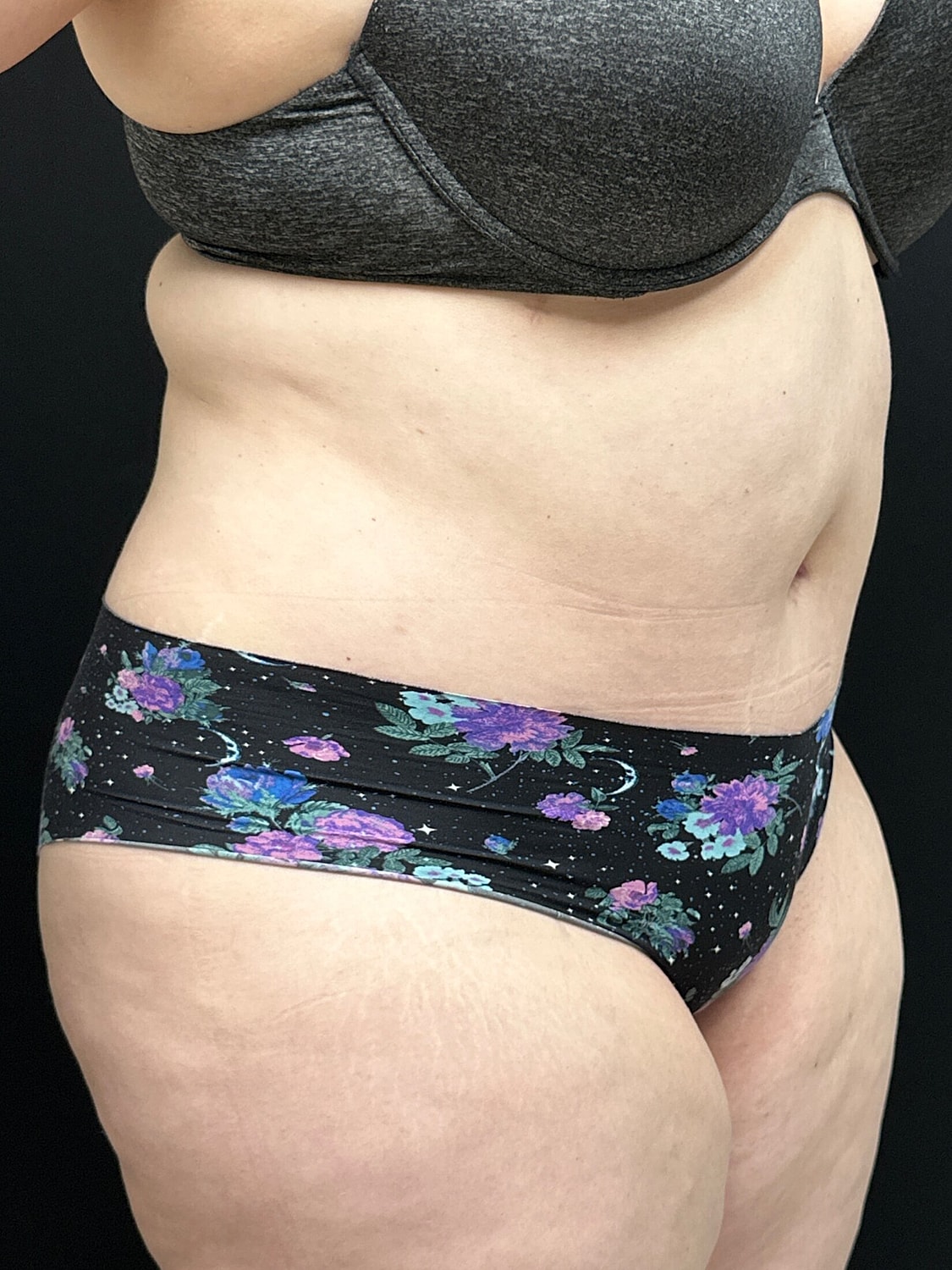 Tummy Tuck Before & After