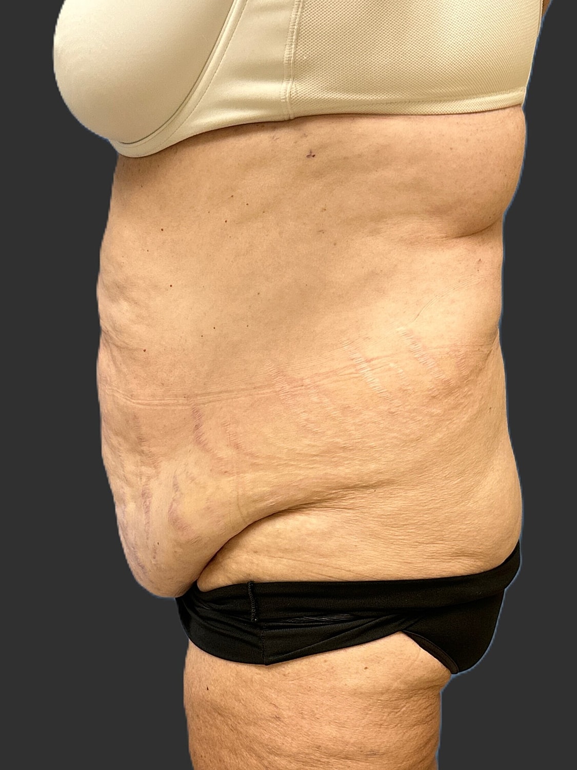 Tummy Tuck Before & After