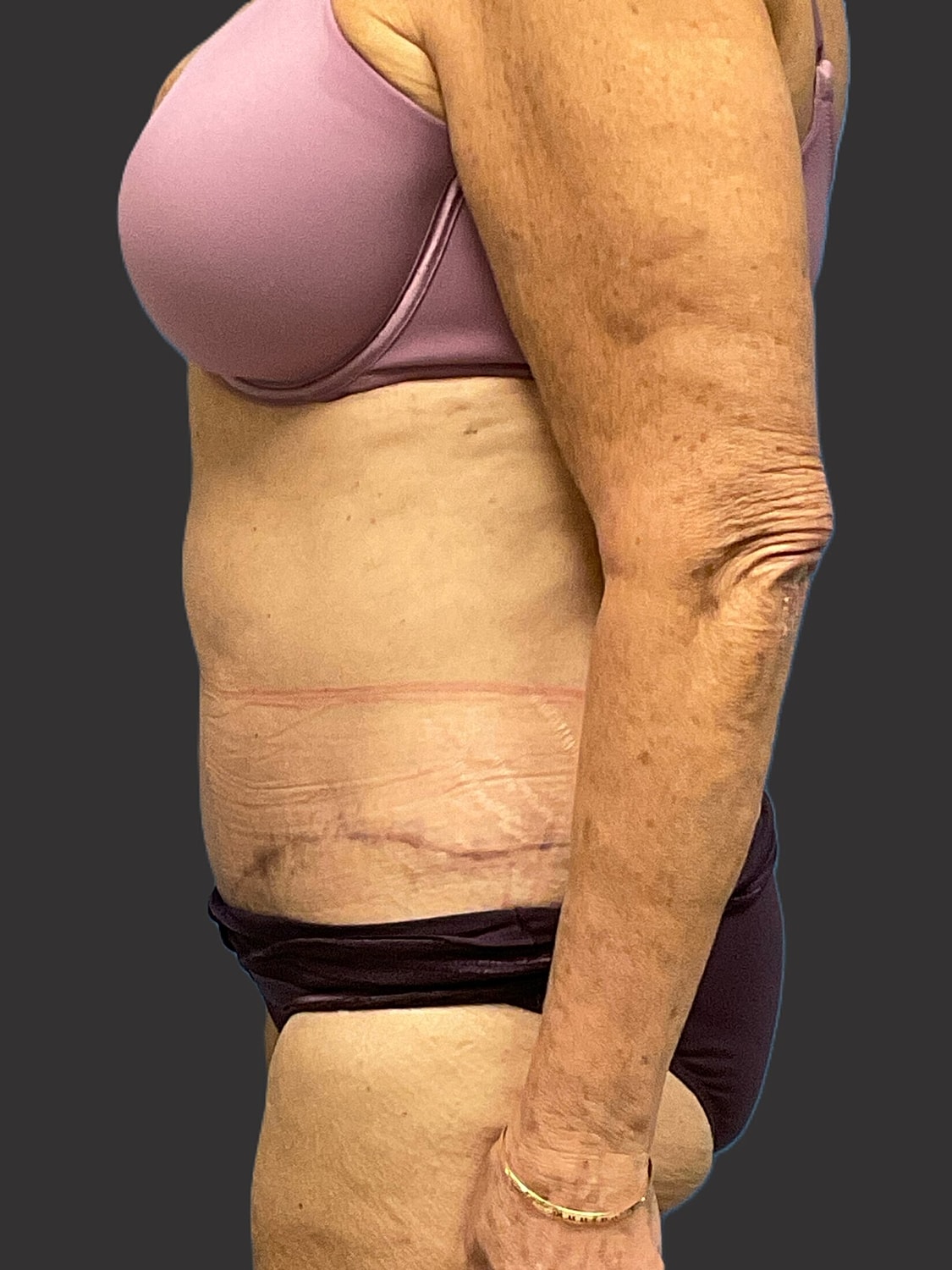 Tummy Tuck Before & After