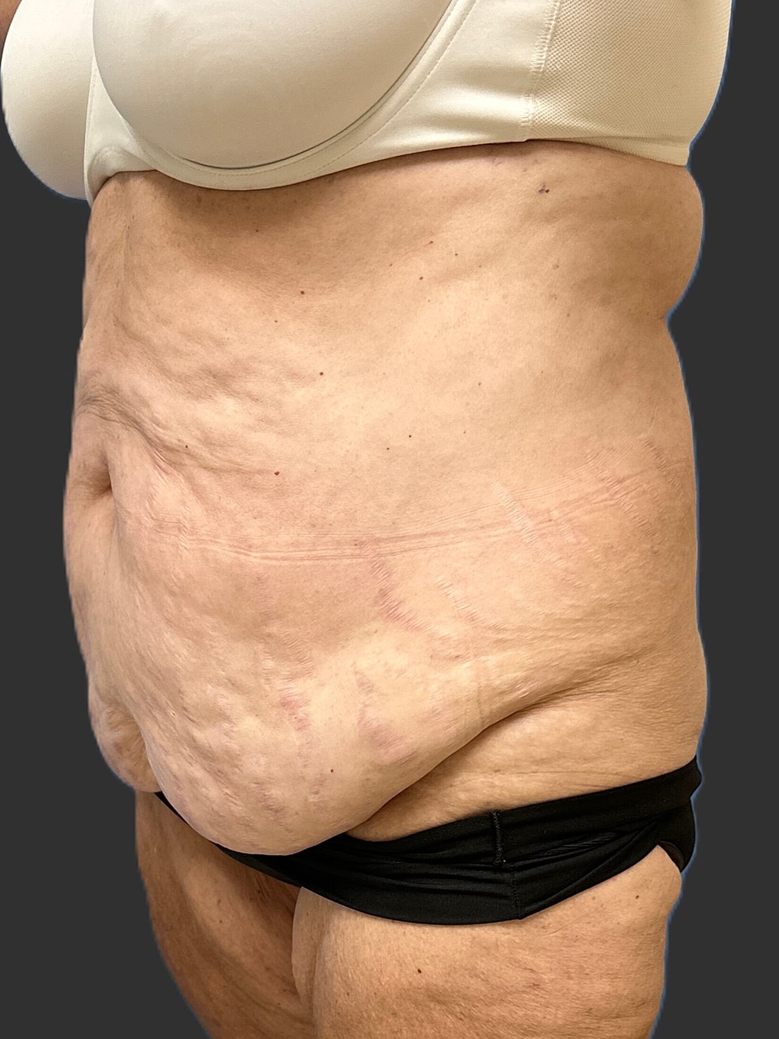 Tummy Tuck Before & After