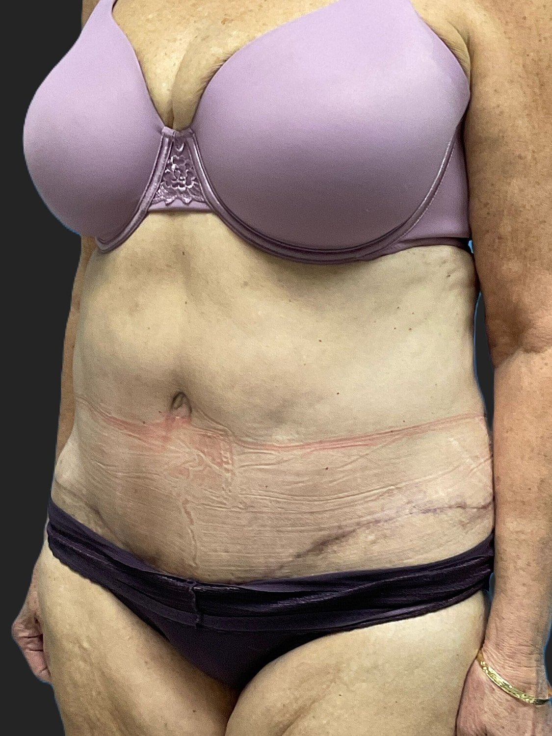 Tummy Tuck Before & After