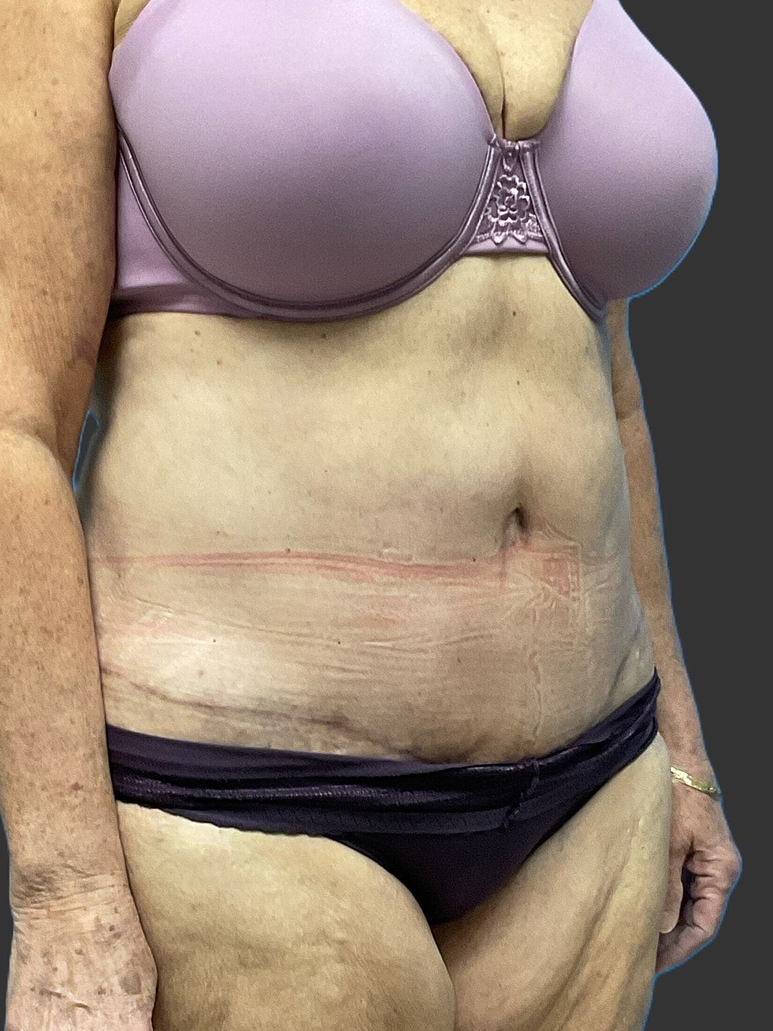 Tummy Tuck Before & After