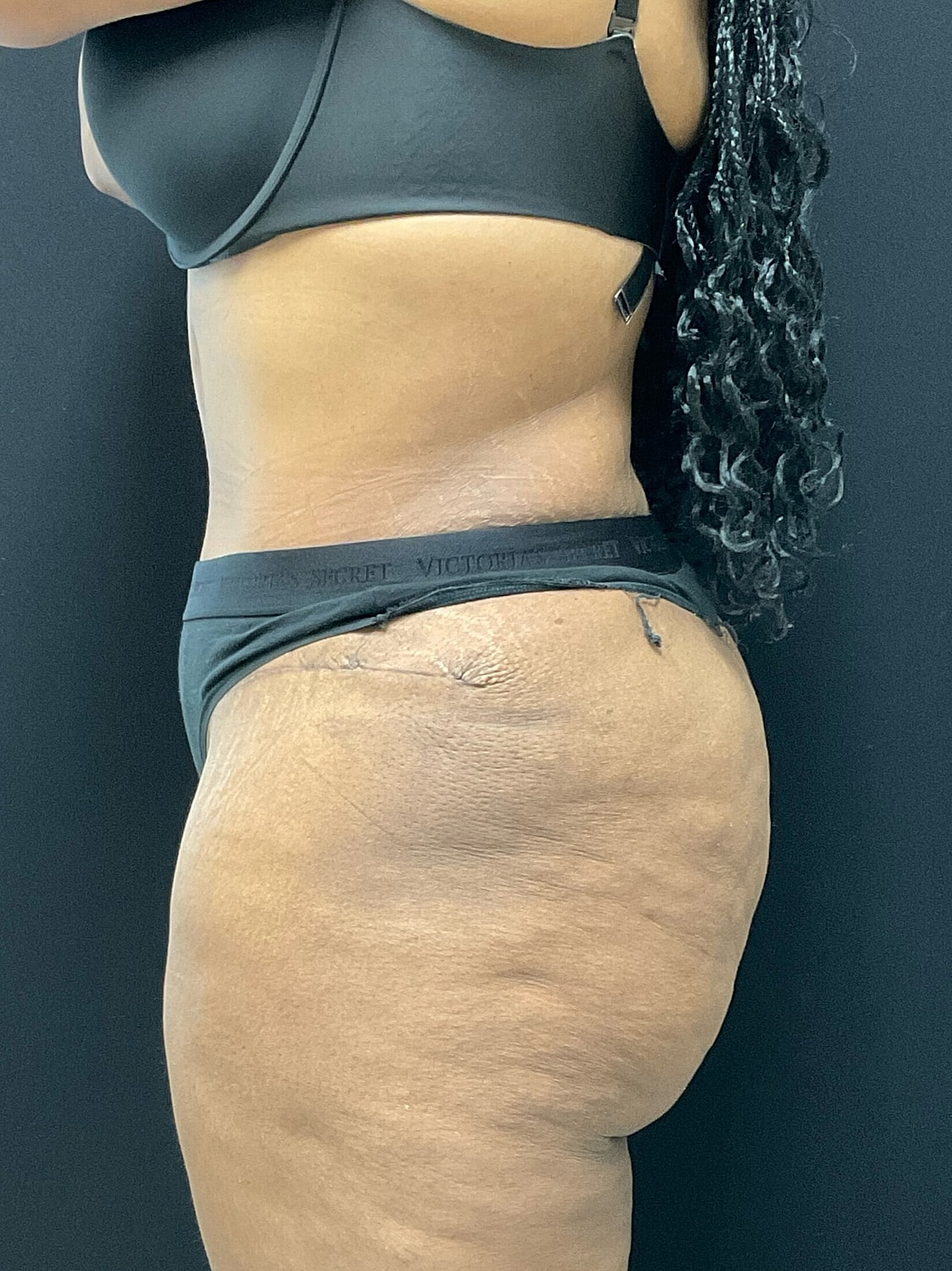 Tummy Tuck Before & After