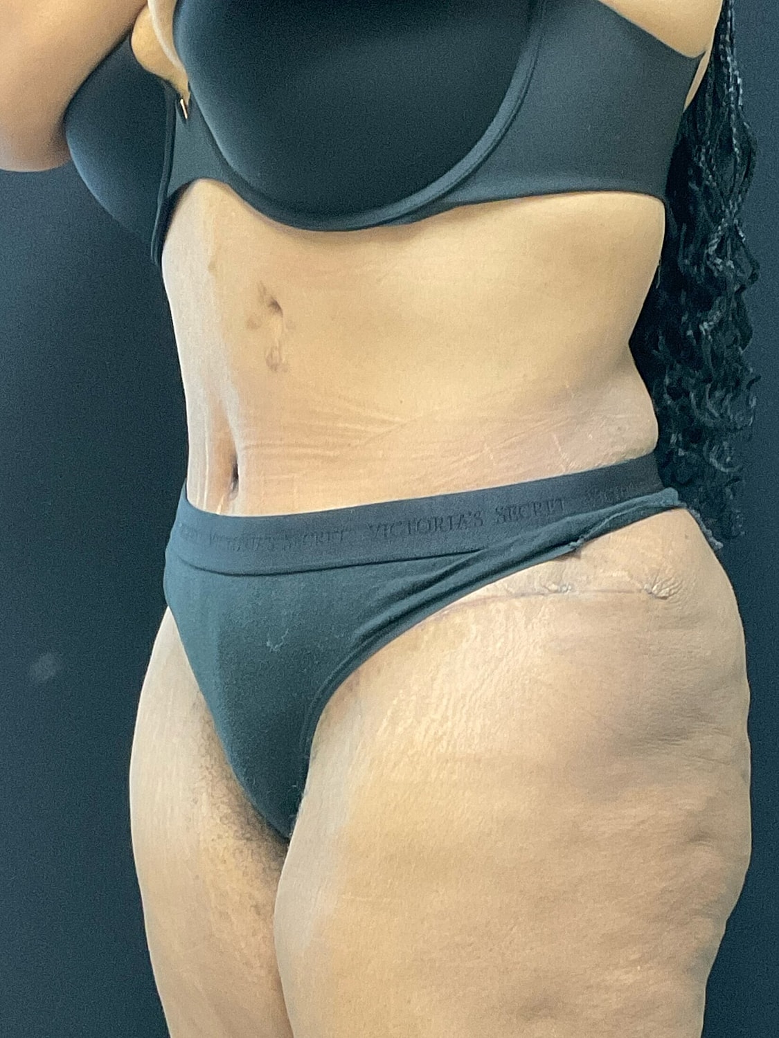 Tummy Tuck Before & After