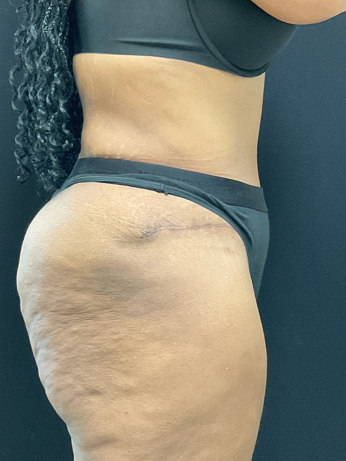 Tummy Tuck Before & After