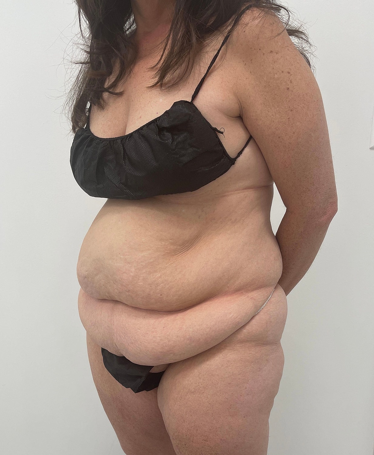 Tummy Tuck Before & After