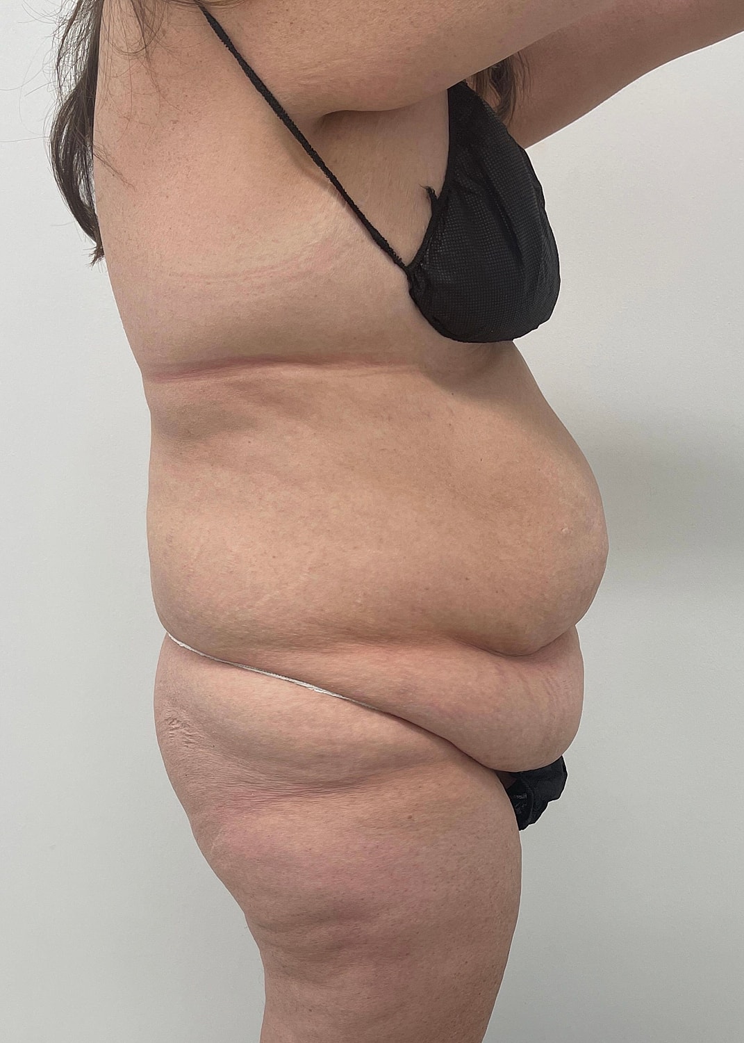 Tummy Tuck Before & After