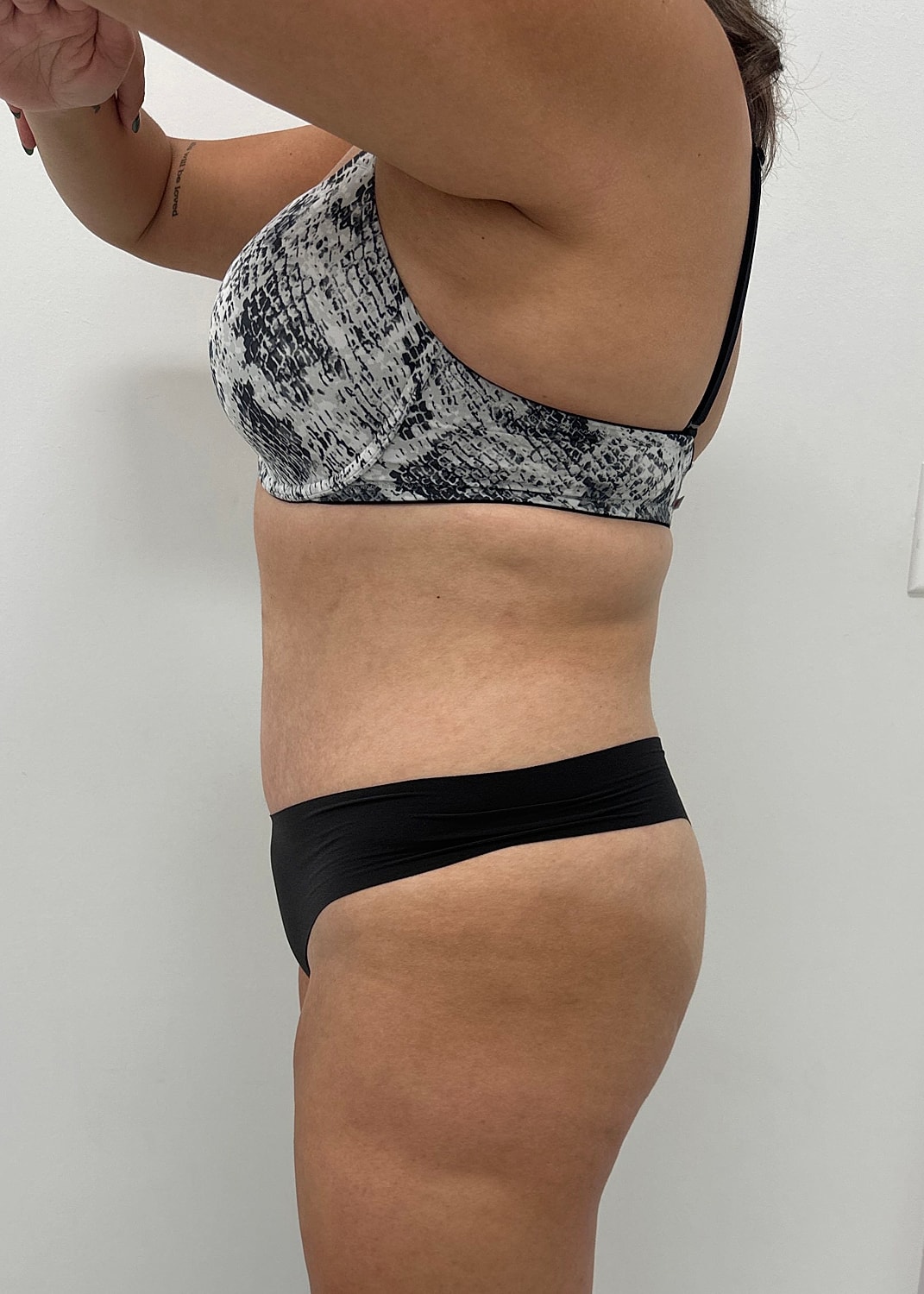 Tummy Tuck Before & After