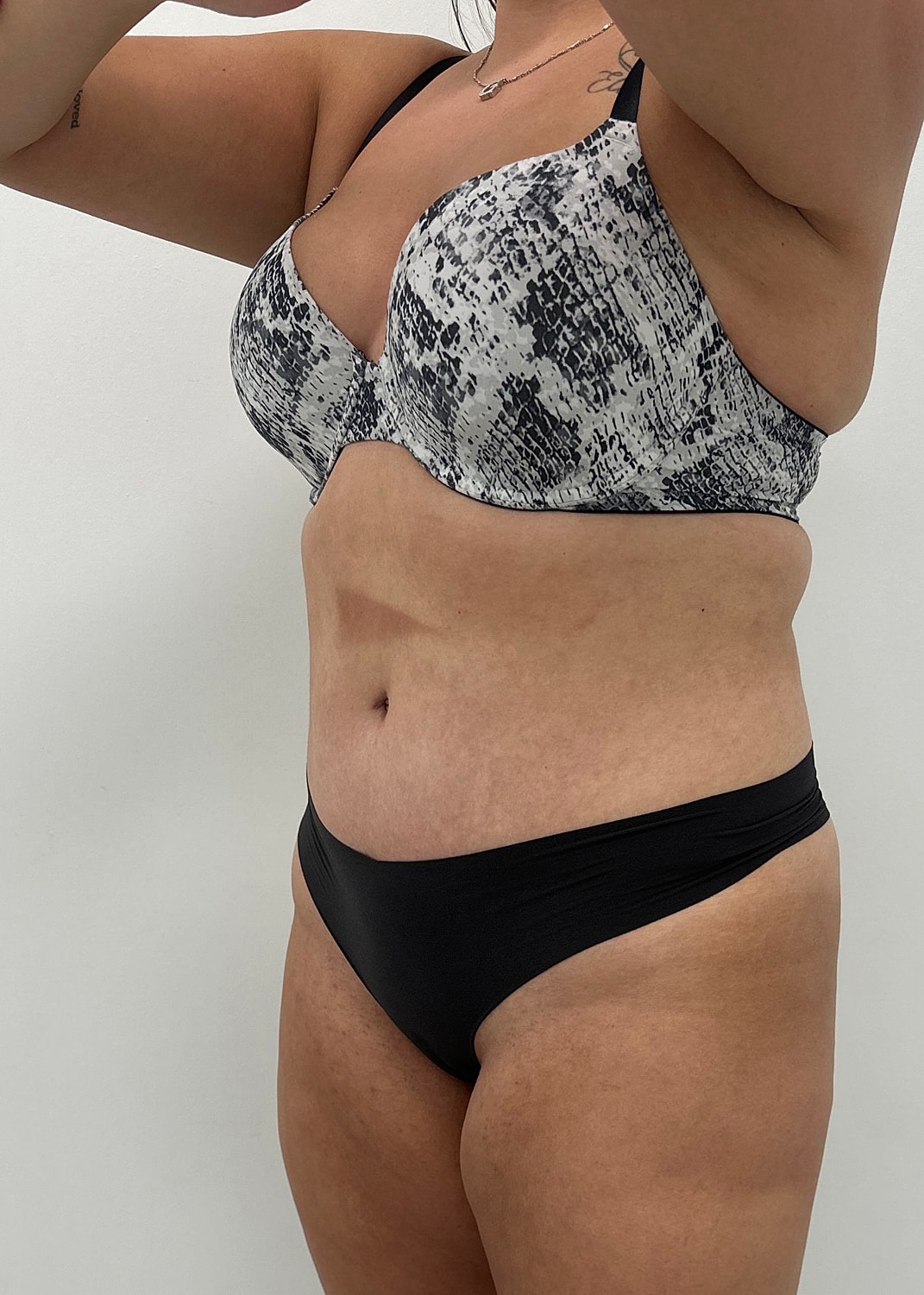 Tummy Tuck Before & After