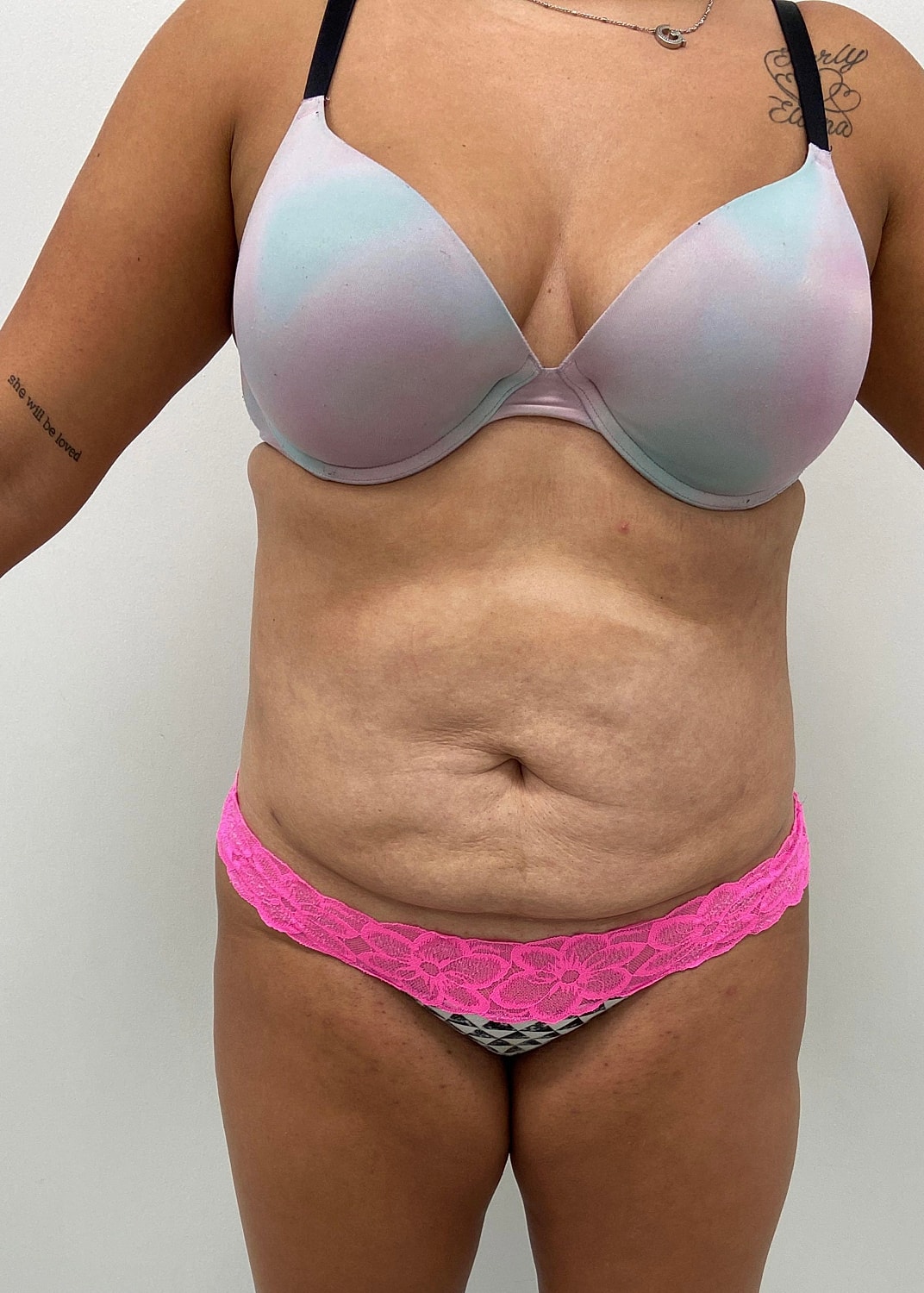 Tummy Tuck Before & After