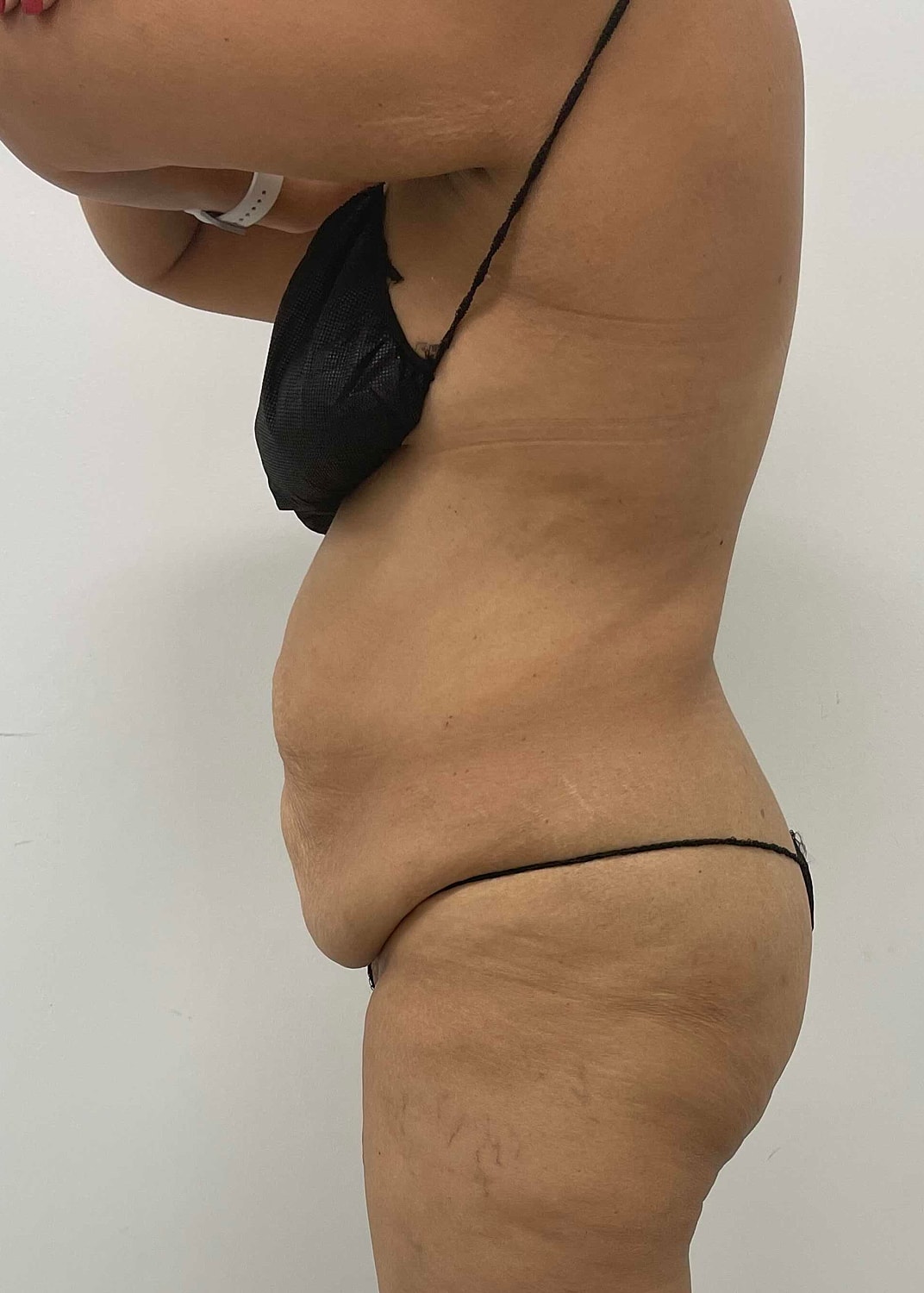 Tummy Tuck Before & After