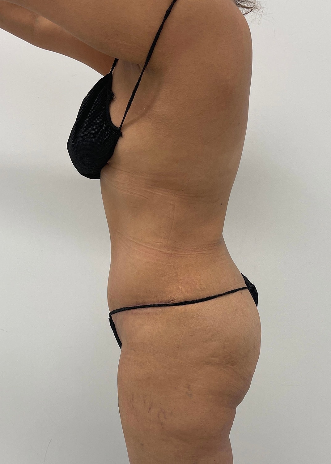 Tummy Tuck Before & After