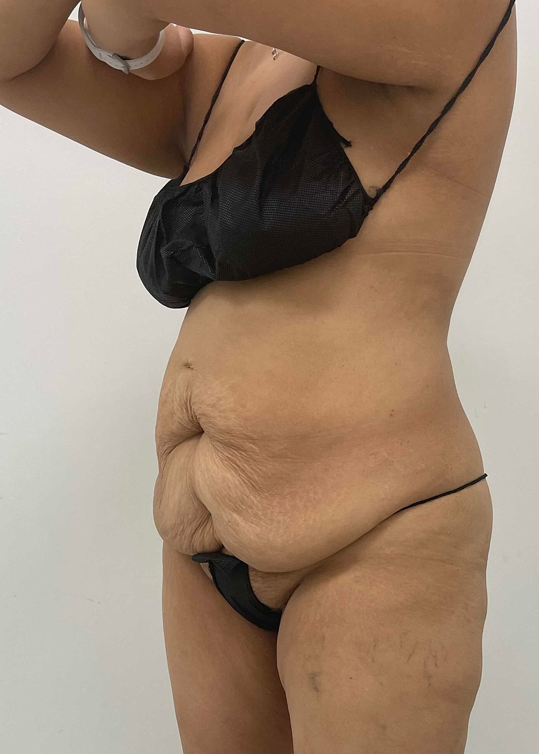 Tummy Tuck Before & After