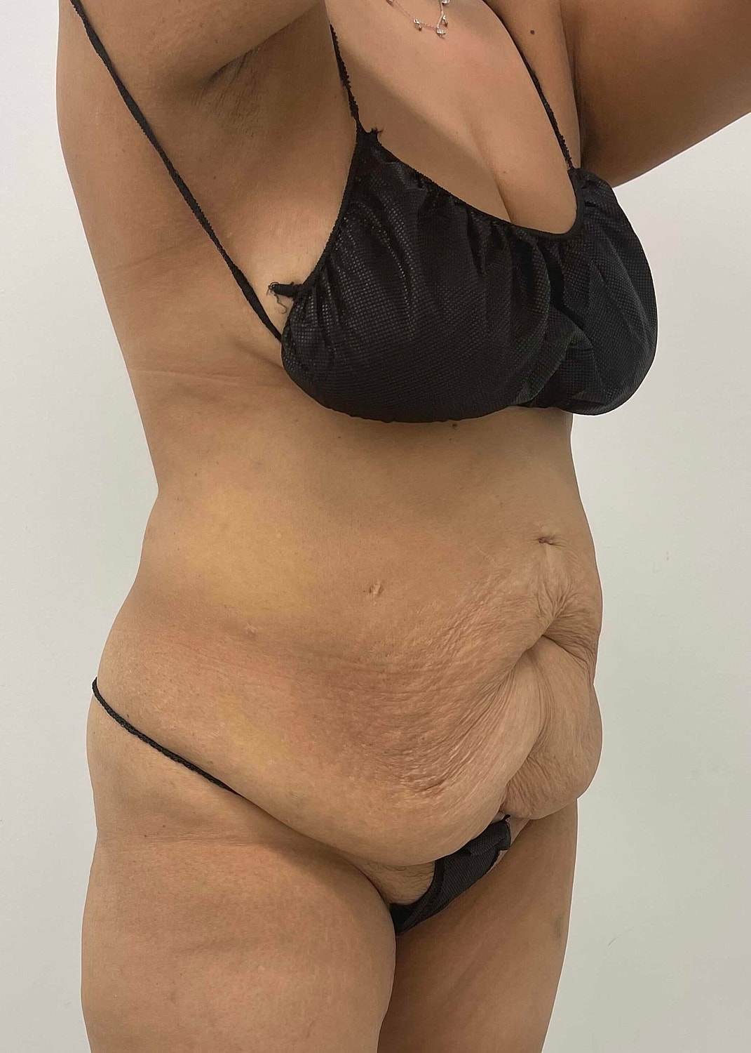 Tummy Tuck Before & After