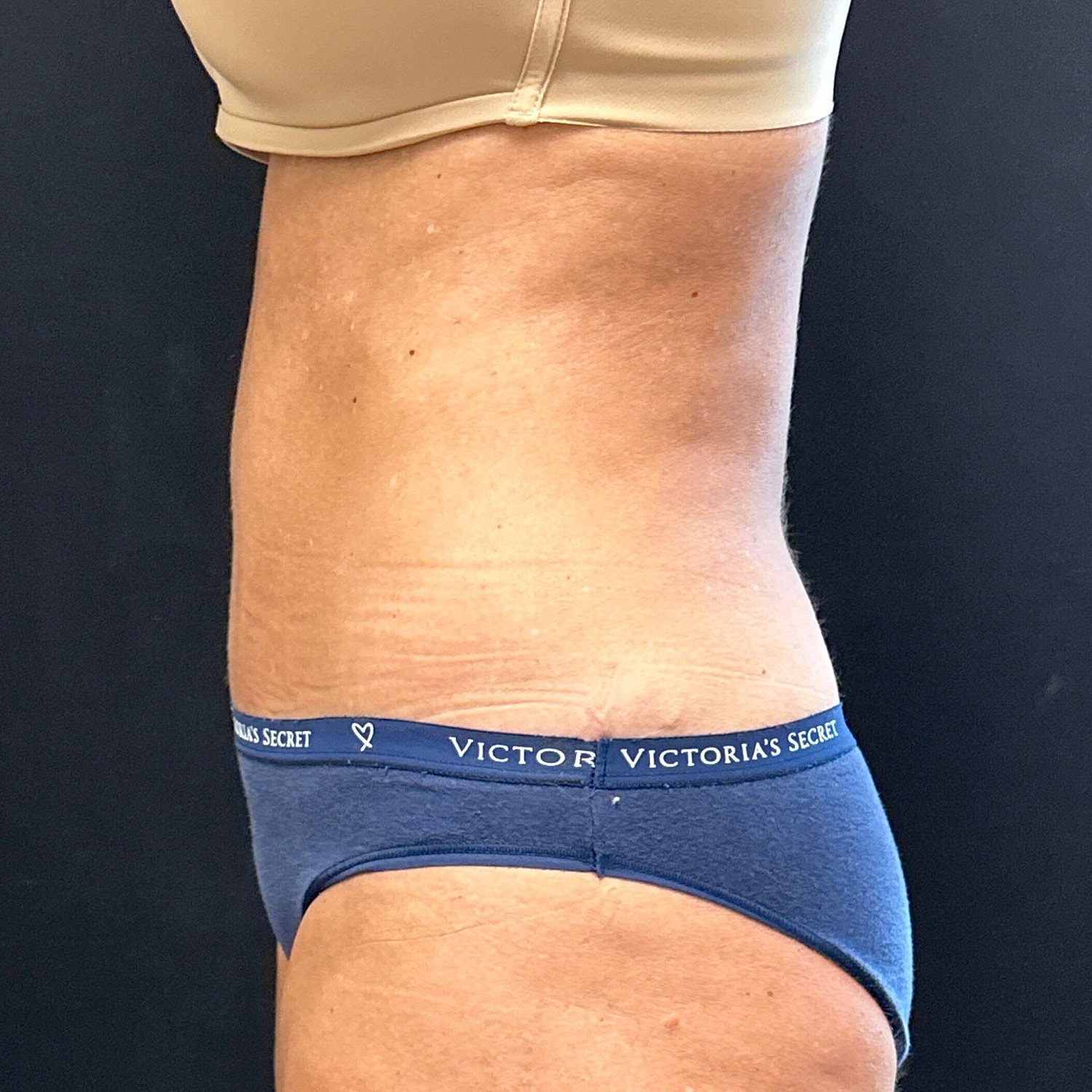 Tummy Tuck Before & After