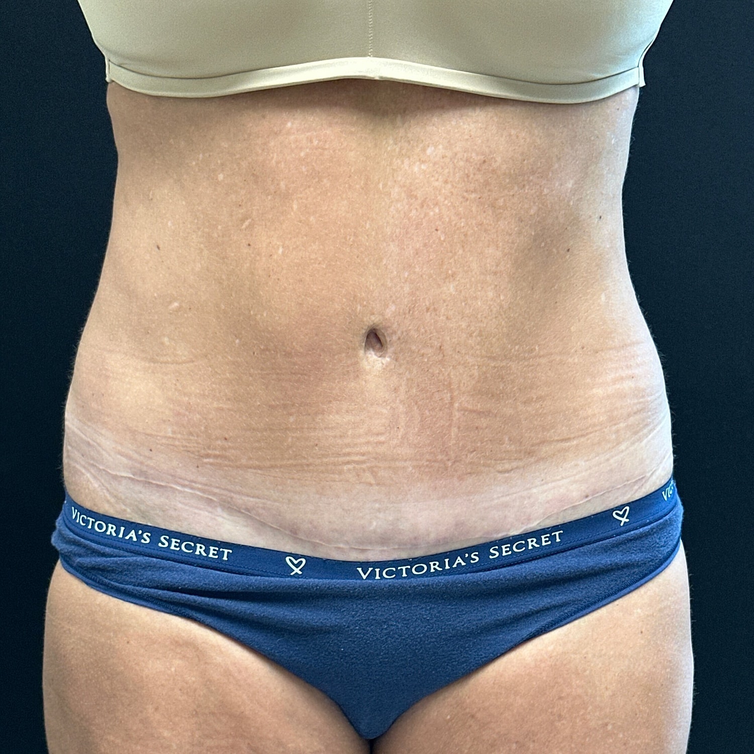 Tummy Tuck Before & After