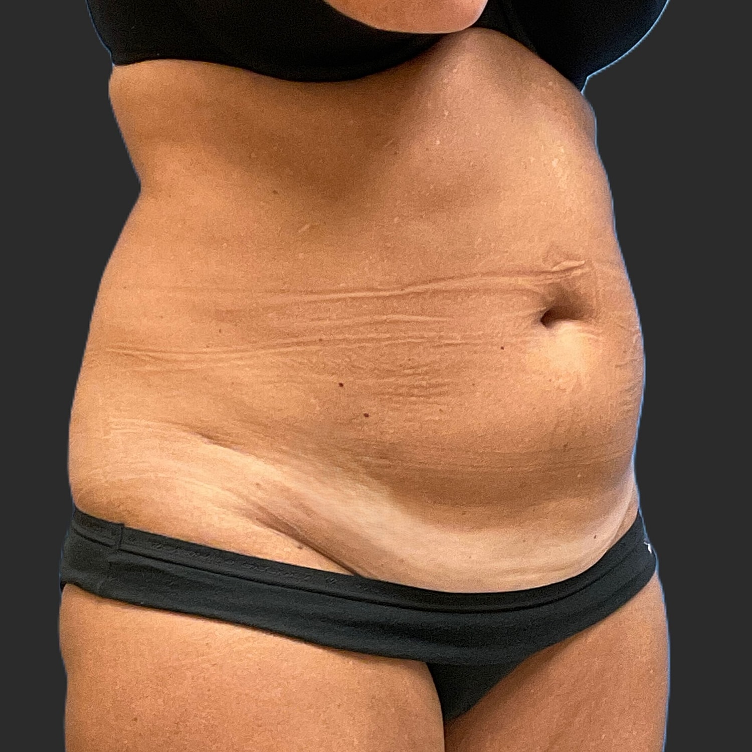 Tummy Tuck Before & After