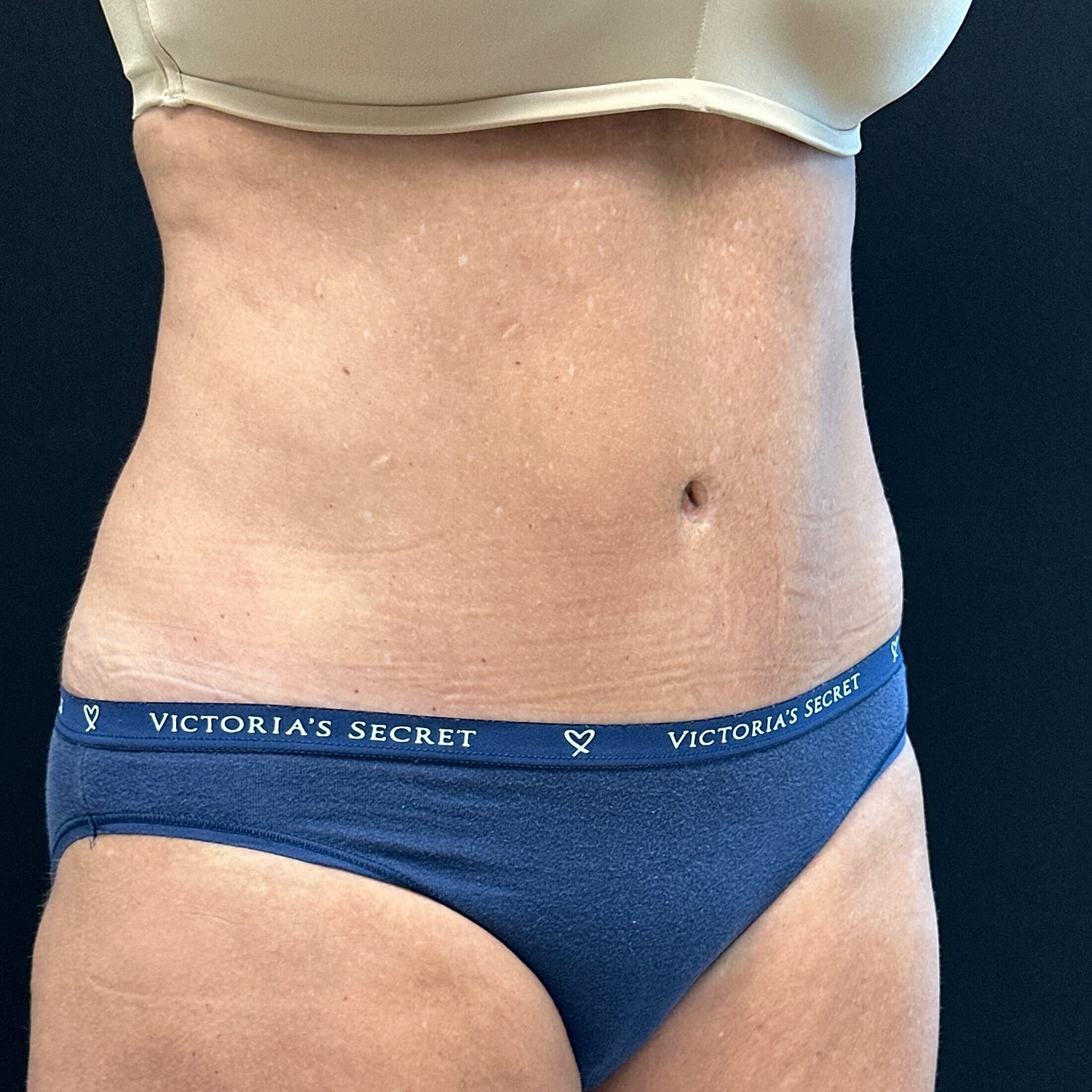 Tummy Tuck Before & After