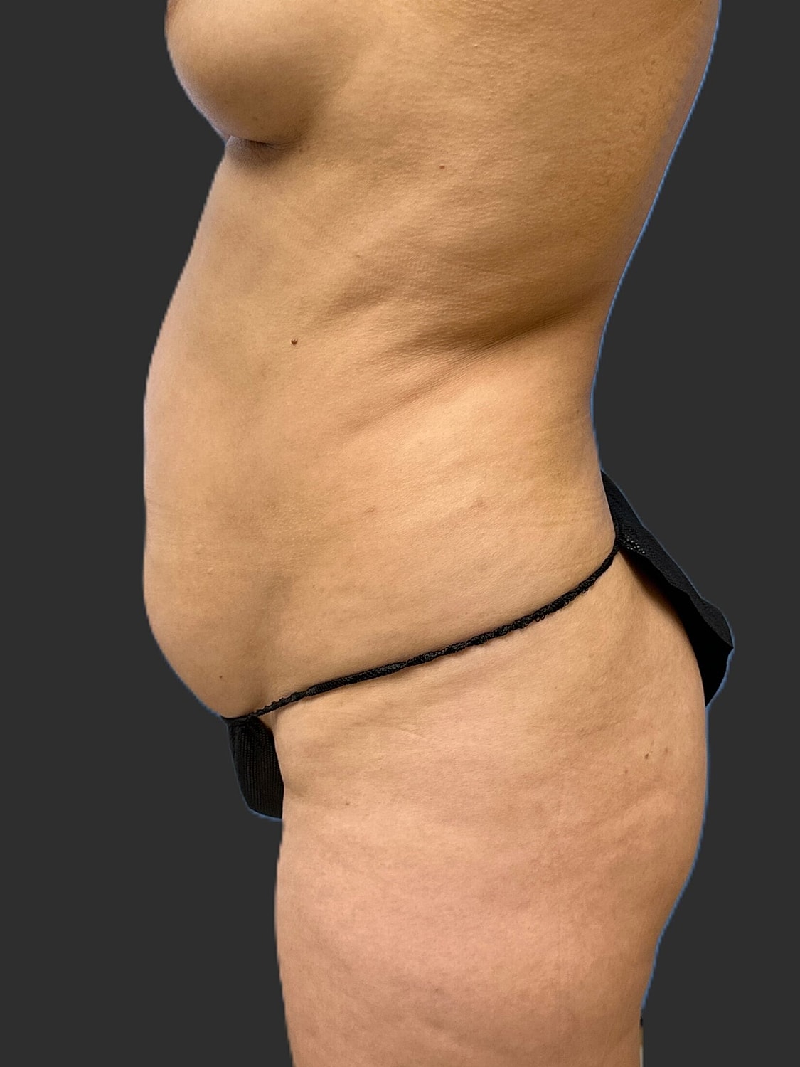 Tummy Tuck Before & After